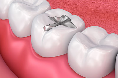 Remmers Dental | Dentures, Cosmetic Dentistry and Implant Dentistry