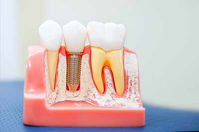 Remmers Dental | CEREC, Invisalign reg  and Root Canals